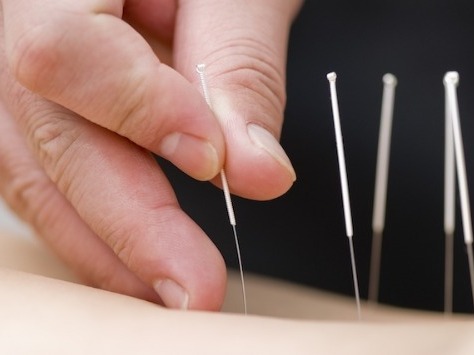 Acupuntura